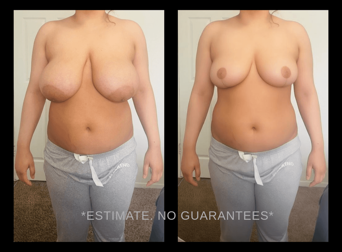 Breast Augmentation simulation example 3