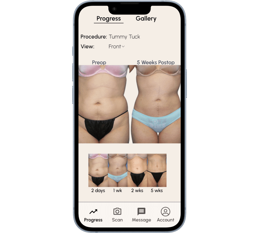 Simulating a Tummy Tuck with Dr. Fan