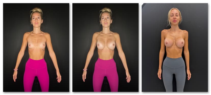 Patient before breast augmentation